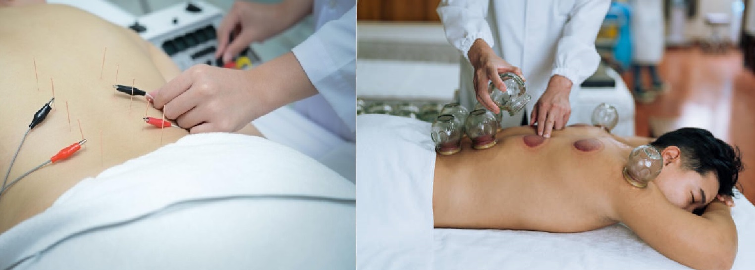 AIMC Dallas Acupuncture For Sciatica and Low Back Pain Cupping Therapy and Electroacupuncture Therapy July 2025 AIMC Dallas Acupuncture For Sciatica and Low Back Pain Cupping Therapy and Electroacupuncture Therapy July 2025