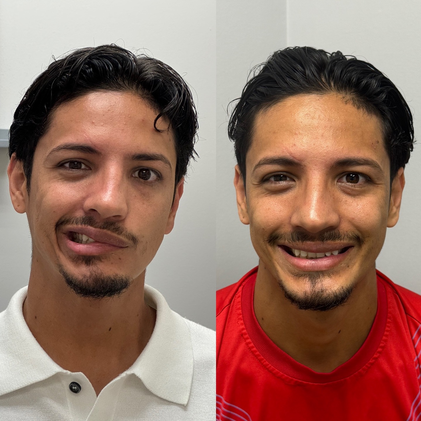 AIMC Dallas Bells Palsy Treatment Experts Hispanic Young Male July 2025