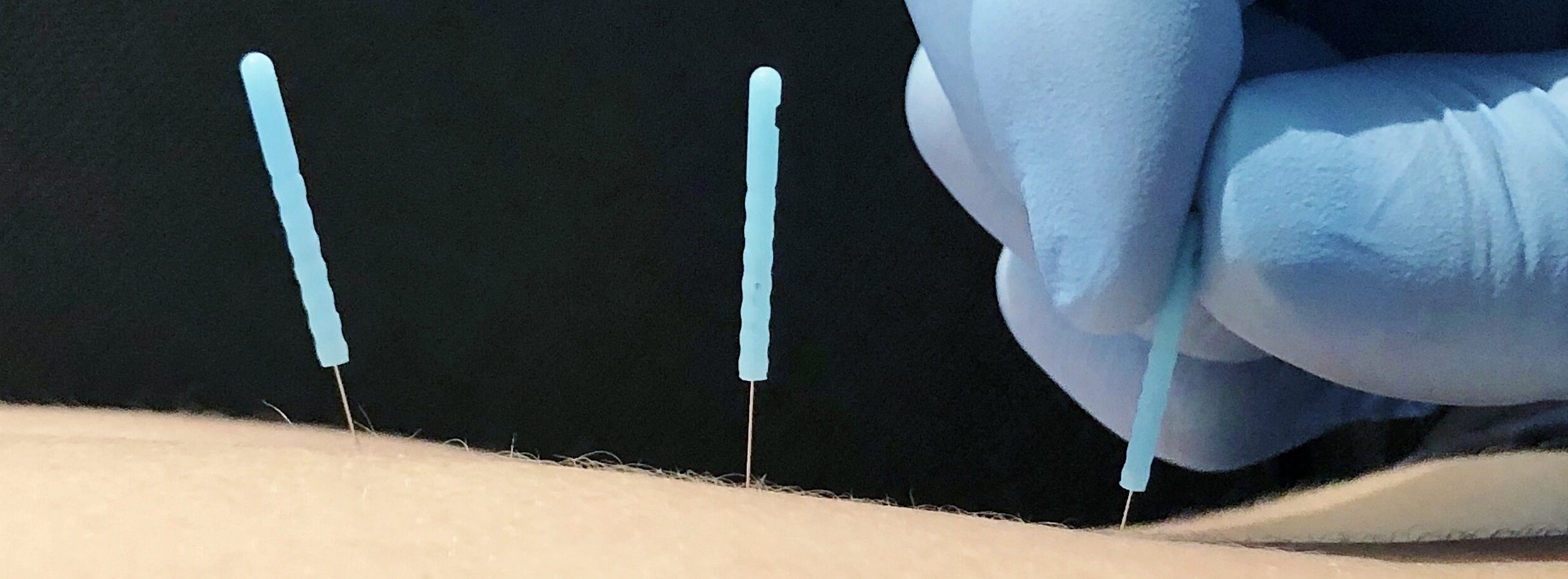 dry-needling for bells palsy recovery