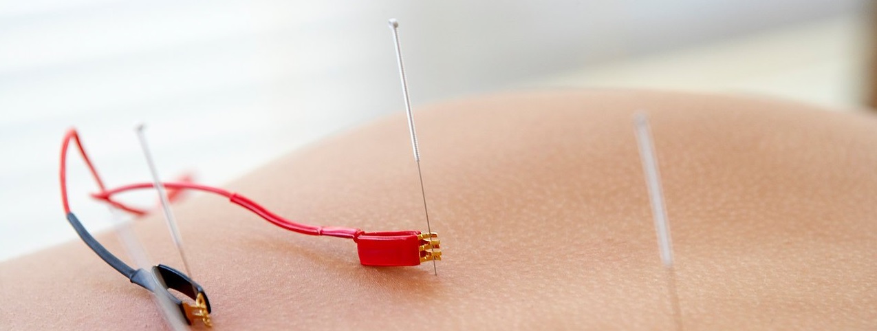 Electric cables attached to acupuncture needles