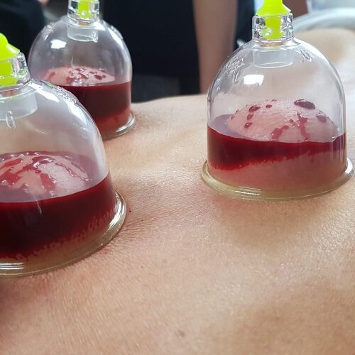 AIMC Wet Cupping AIMC Wet Cupping