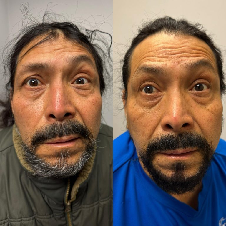 NEW-Bells-Palsy-One-Week-Transformation-Irving-TX-Integrated-Medical-Center-768x768